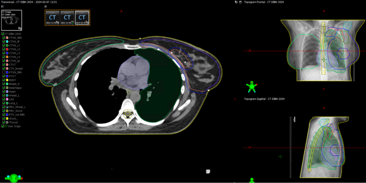 CT-bild av br&ouml;stkorg