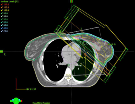 CT-bild av br&ouml;stkorg