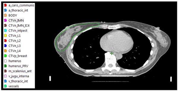 CT-bild av br&ouml;stkorg