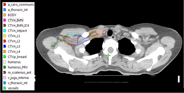 CT-bild av br&ouml;stkorg