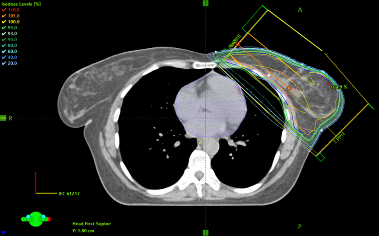 CT-bild av br&ouml;stkorg