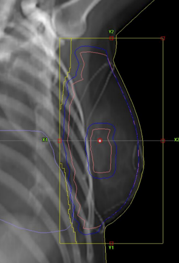 CT-bild av br&ouml;stkorg