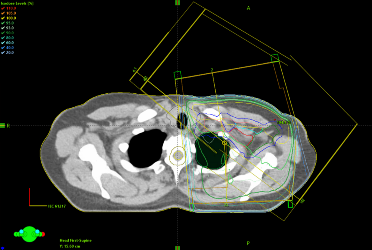 CT-bild av br&ouml;stkorg