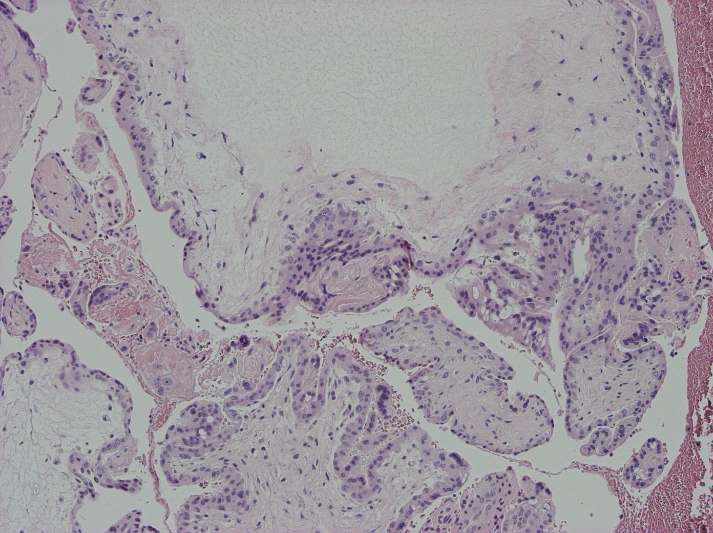 Kap 10.2.3 Figur 8. Partiell mola HE.jpg