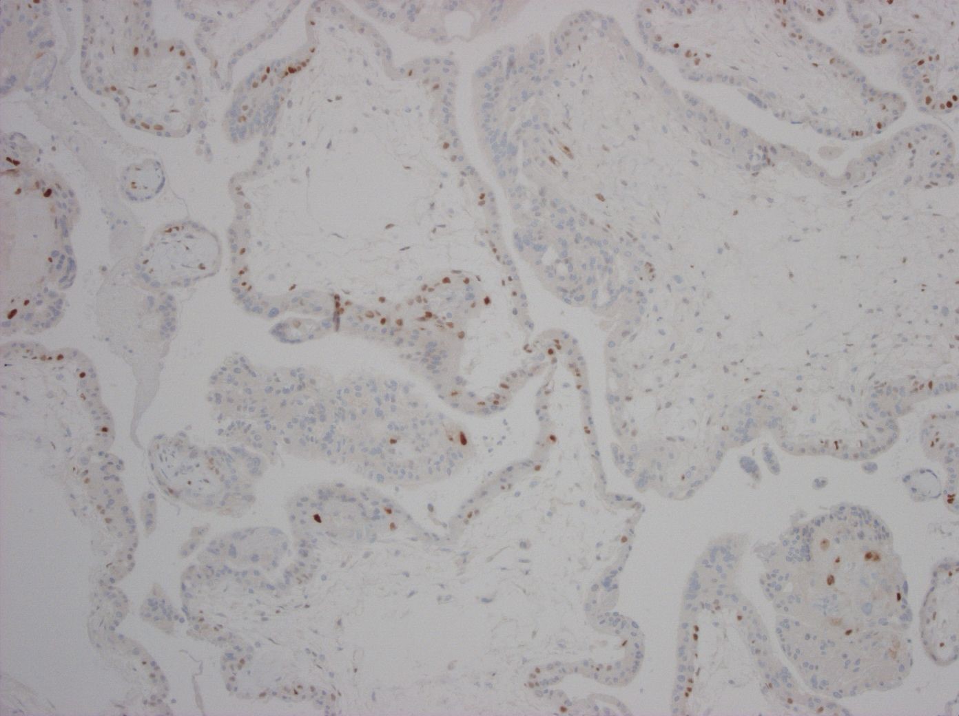 Kap 10.2.3 Figur 9. Partiell mola p57KIP..jpg