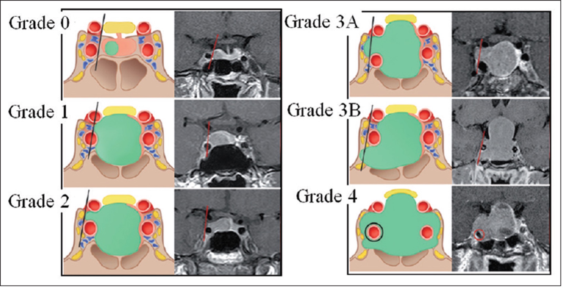 Figurer som visar grad 0 till 4 enligt KNOSP