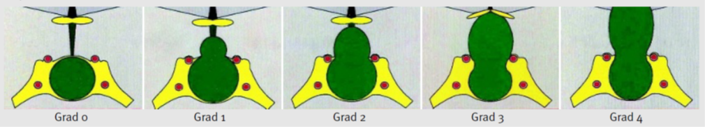 Figurer som visar grad 0 till 4 enligt SIPAP