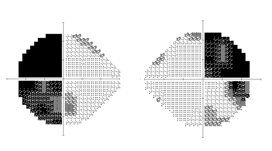 Figur som visar synf&auml;ltsdefekt