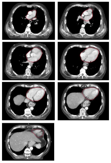 Bilaga 2 Contouring atlas heart 1.png