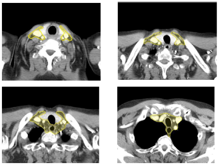 Bilaga 2 Contouring atlas heart 2.png