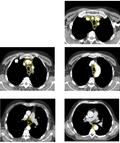 Bilaga 2 Contouring atlas heart 3.png