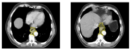 Bilaga 2 Contouring atlas heart 4.png