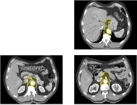 Bilaga 2 Contouring atlas heart 5.png
