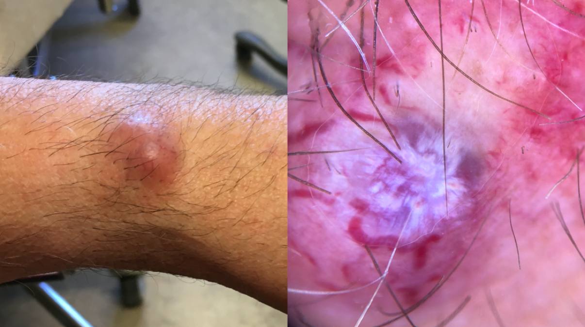 01Primär MCC underarm.jpg