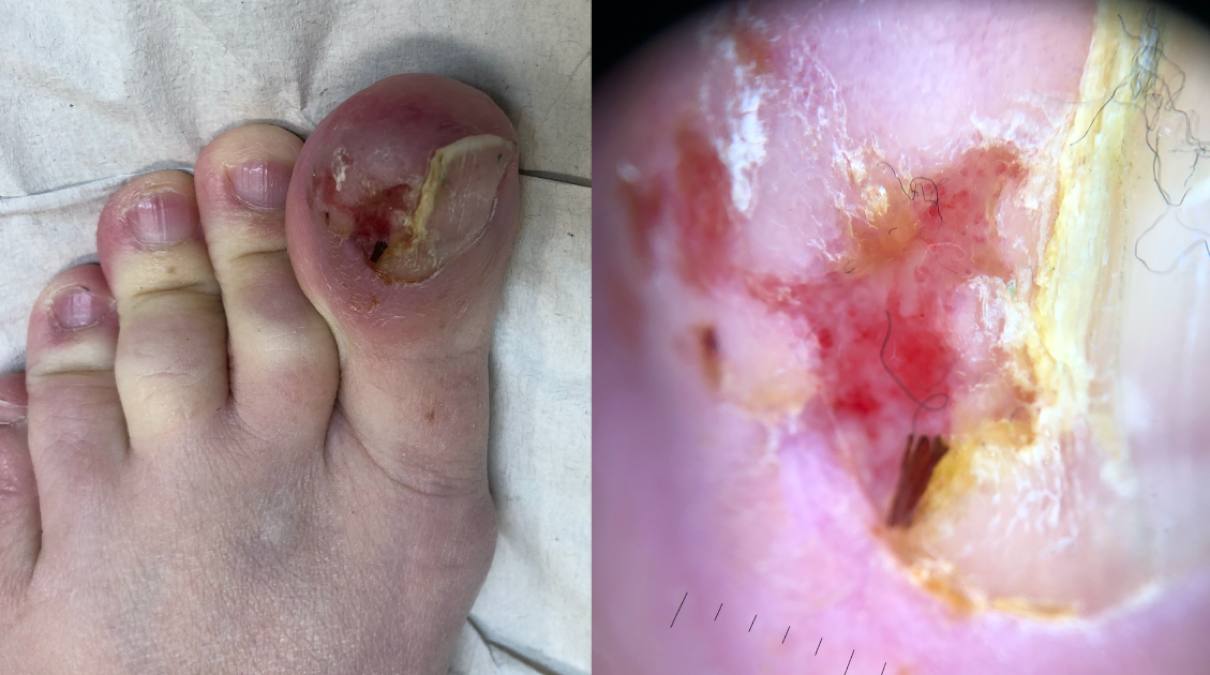 02Primär MCC vänster stortå.jpg