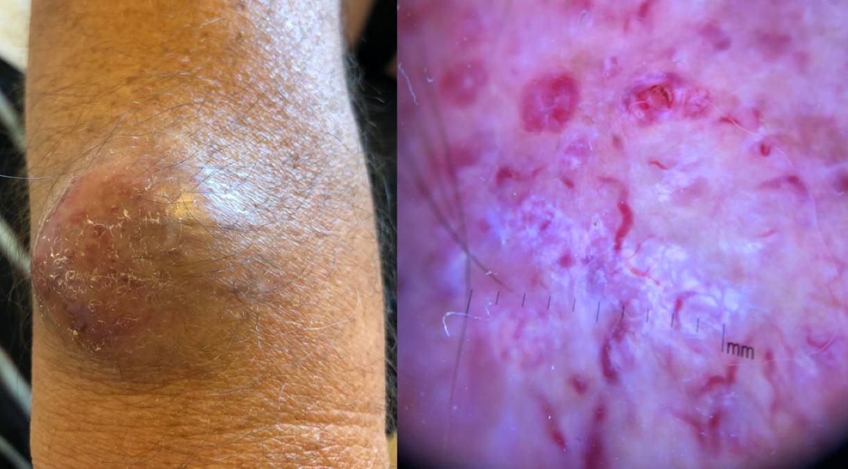 03Primär MCC vrist.jpg