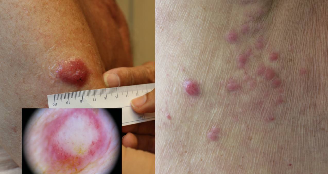 04Primär MCC, överarm, med metastaser på bröstet.jpg