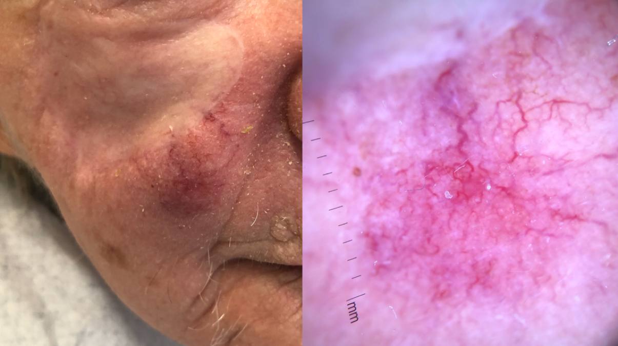 05Recidiv av MCC, höger kind.jpg