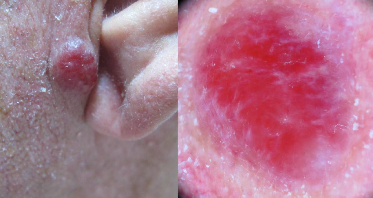 06Primär MCC vid örat.jpg