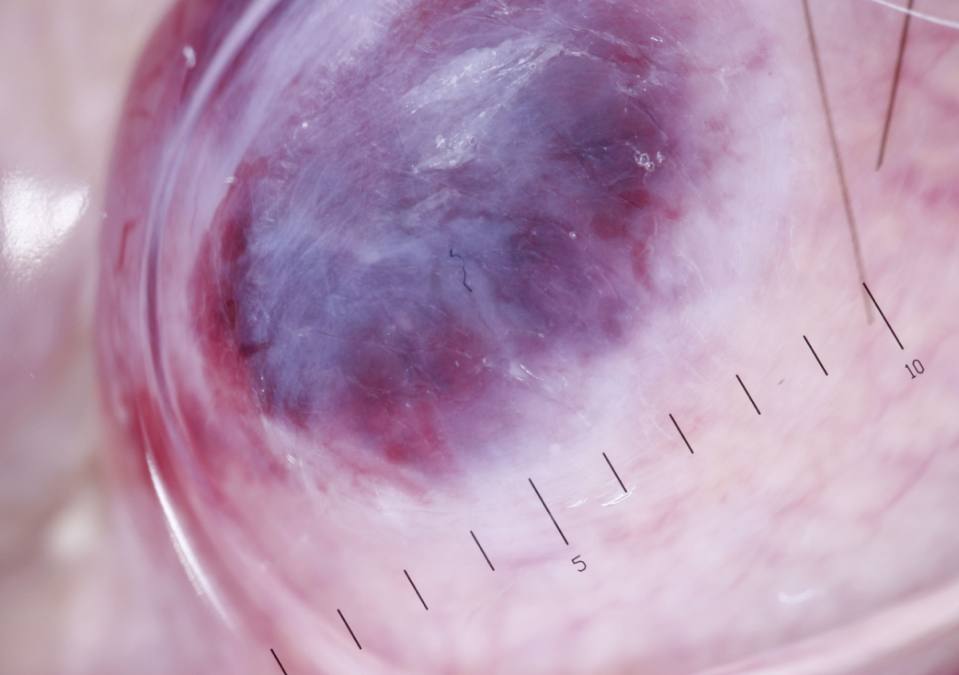 07MCC sett genom dermatoskop.jpg
