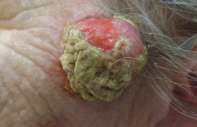 08iPrimär MCC tinning.jpg