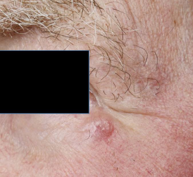 09Primär MCC intill nedre ögonlock.jpg