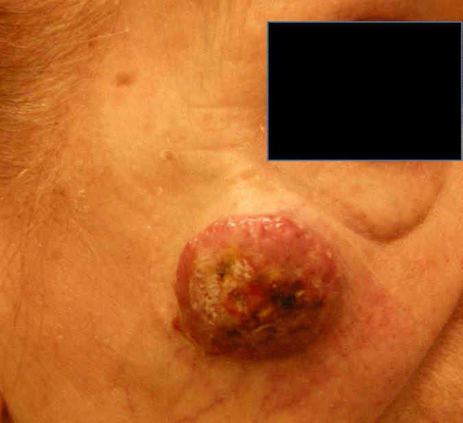 10Primär MCC, höger kind.jpg