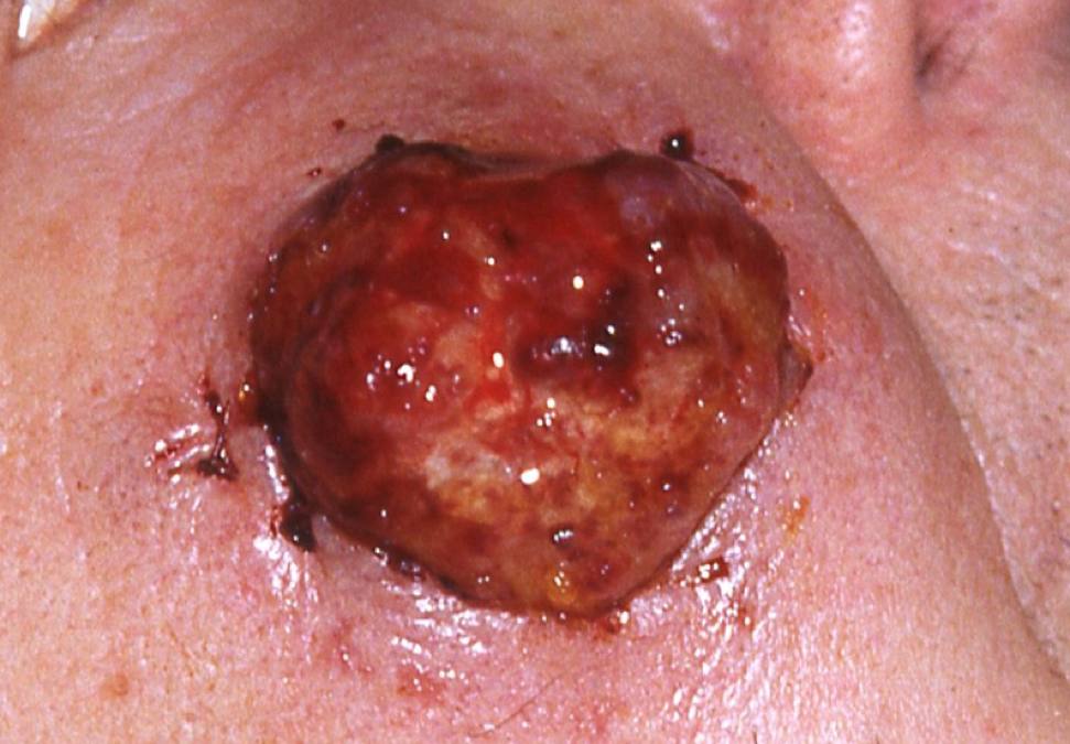 11Primär MCC kind.jpg