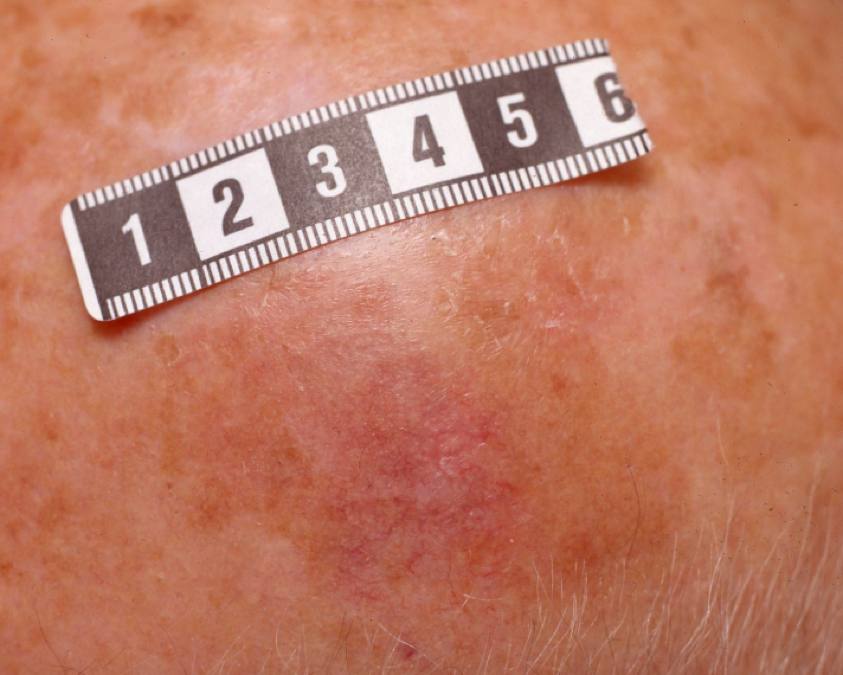 12Primär MCC skalp.jpg