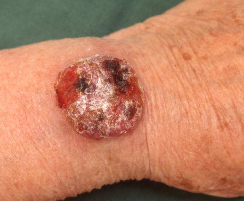 13Primär MCC, handled.jpg