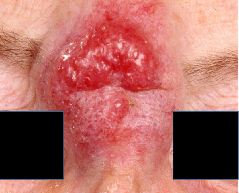 14Primär MCC, glabella.jpg