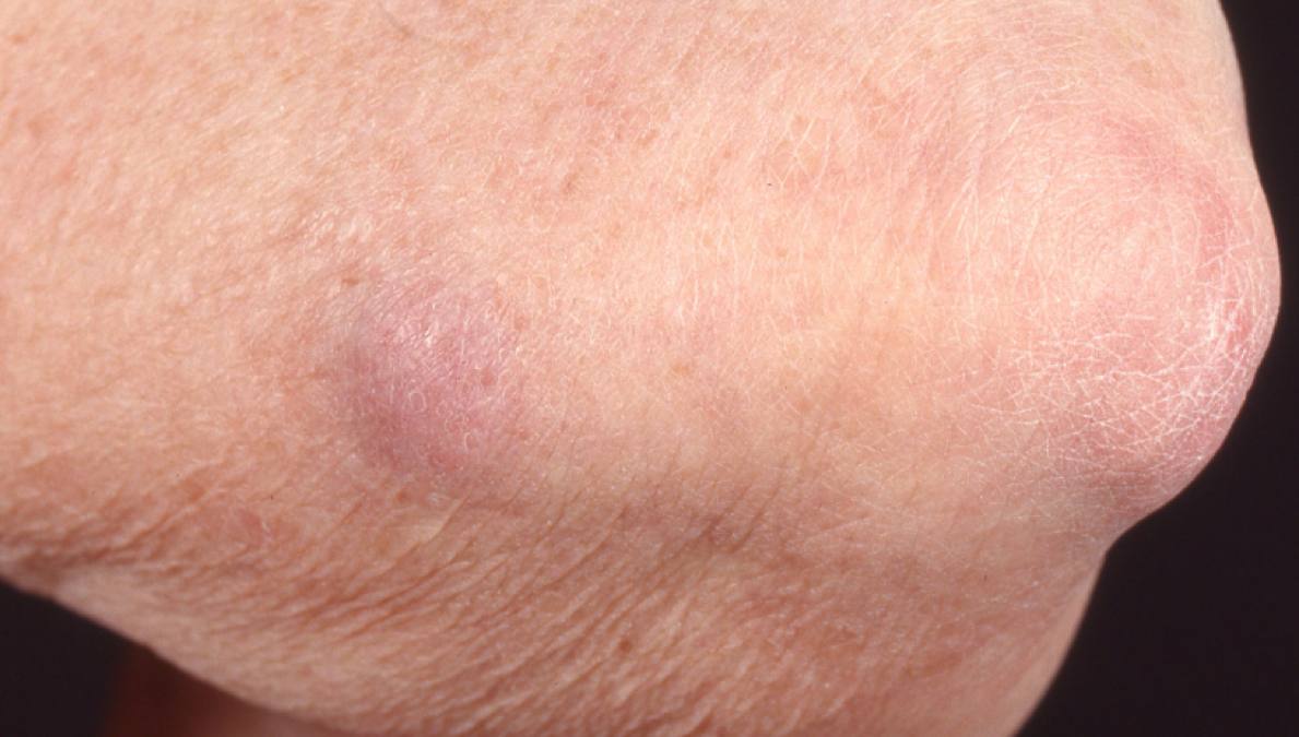 15Primär MCC subkutant, sträcksida armbåge.jpg