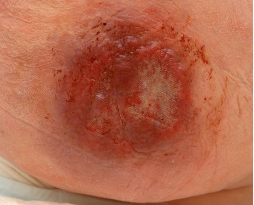 16Primär MCC, klinka.jpg