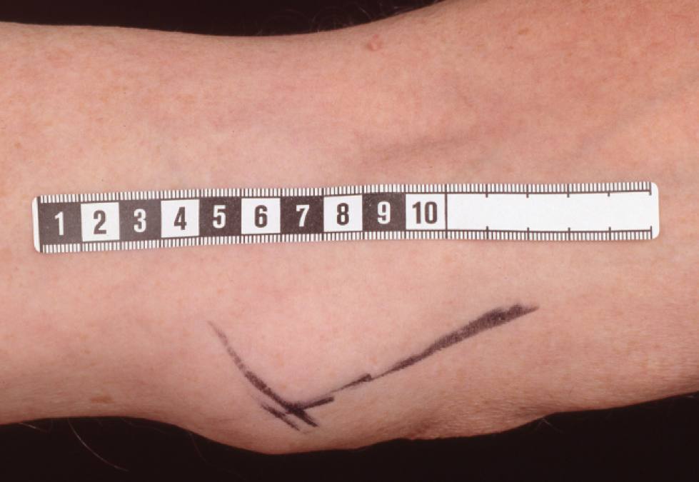 17Primär MCC, sträcksida armbåge.jpg