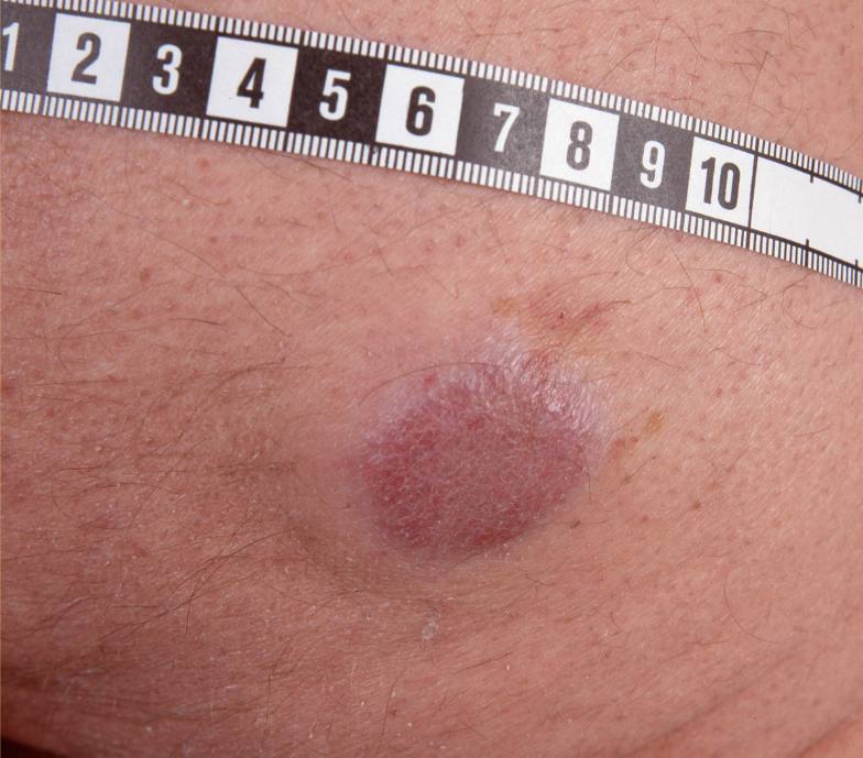 18Primär MCC, klinka.jpg