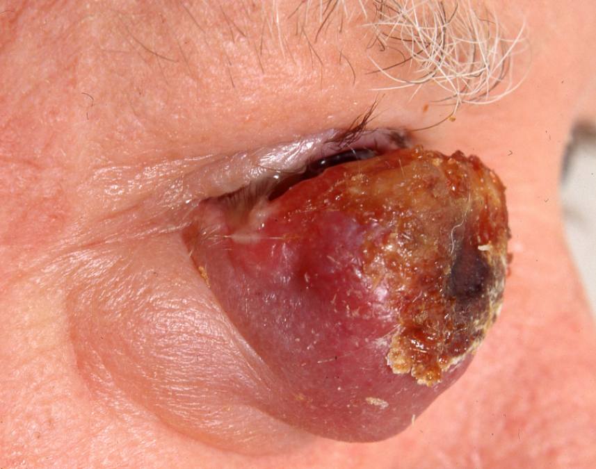 20Primär MCC, undre ögonlock.jpg