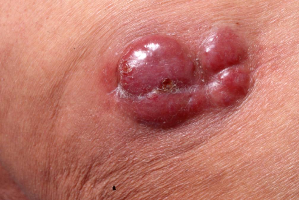 22MCC på klinka med ärr efter tidigare biopsi.jpg