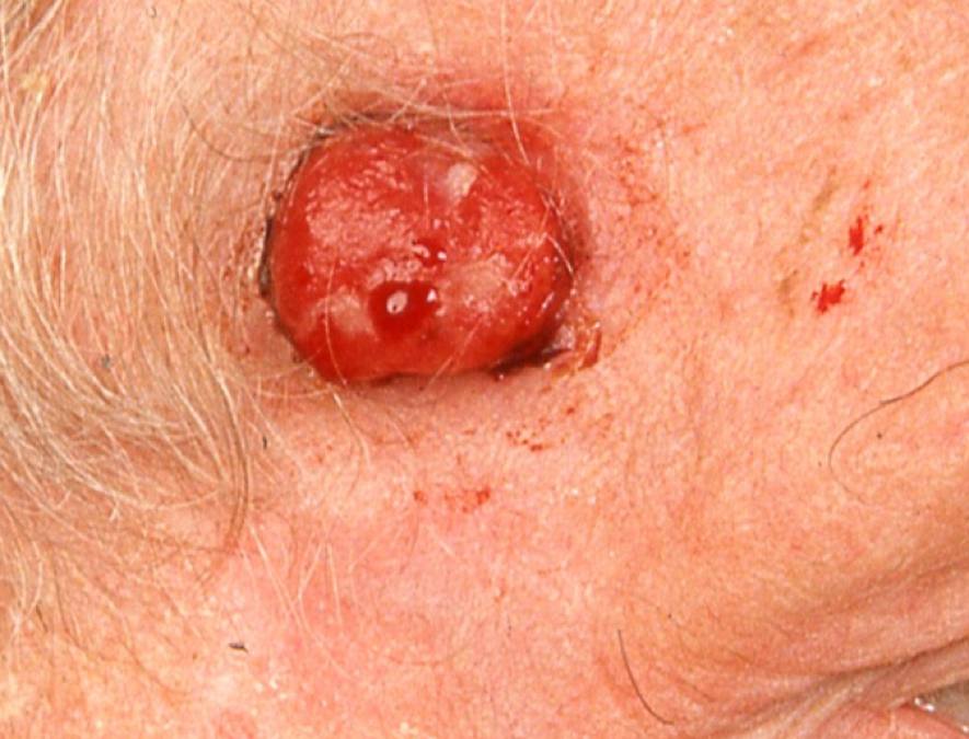 23Primär MCC tinning.jpg