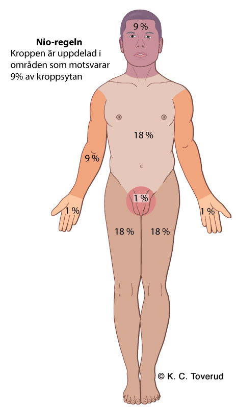 Illustration av m&auml;nniskokropp som &auml;r inledad i sex olikf&auml;rgade delar med utskrivna procentsatser: huvud 9 %, armar 9 %, h&auml;nder 1 %, torso 18 %, genitalier 1 %, ben 18 %