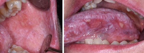 Foto p&aring; insidan av kinden och sidan av tungan