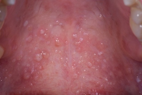 Foto p&aring; mukocele i mjuka gommen