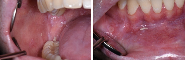 Foto p&aring; insida av kind, nedre tandrad och insida av underl&auml;pp