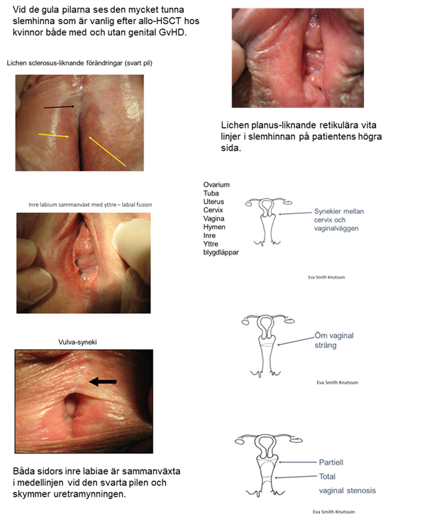 Foton och illustrationer som visar yttre och inre delar av kvinnlig genitalia. Fotona visar exempel p&aring; effekter efter allo-HSCT och exempel p&aring; genital GvHD